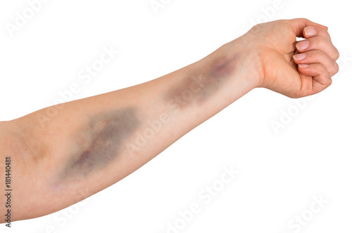 Large bruise on human arm photo