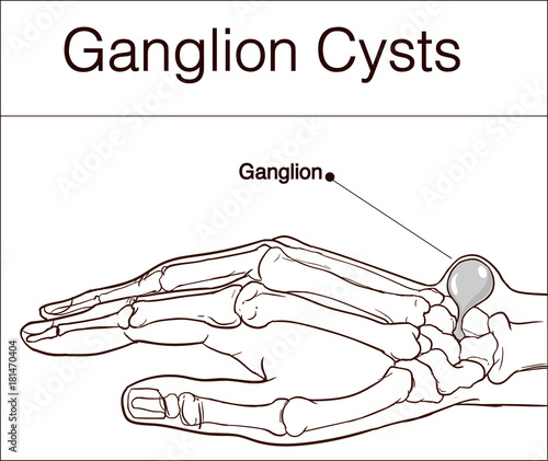 vector illustration of a Ganglion cyst