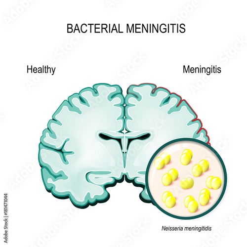 Meningitis. Human brain and meningococcal bacteria.