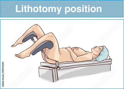 Lithotomy position