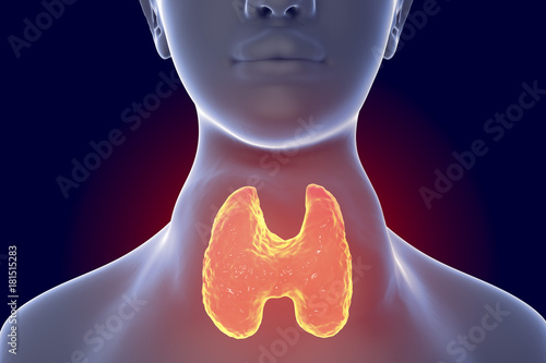 Toxic diffuse goiter, Flajani-Basedow-Graves' disease. 3D illustration showing enlarged thryoid gland in a female with hyperthyroidism photo