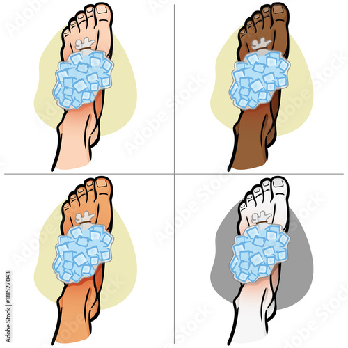 Illustration of firs aid person ethnicity, foot with ice bag, top view. Ideal for catalogs, information and medicine guides
