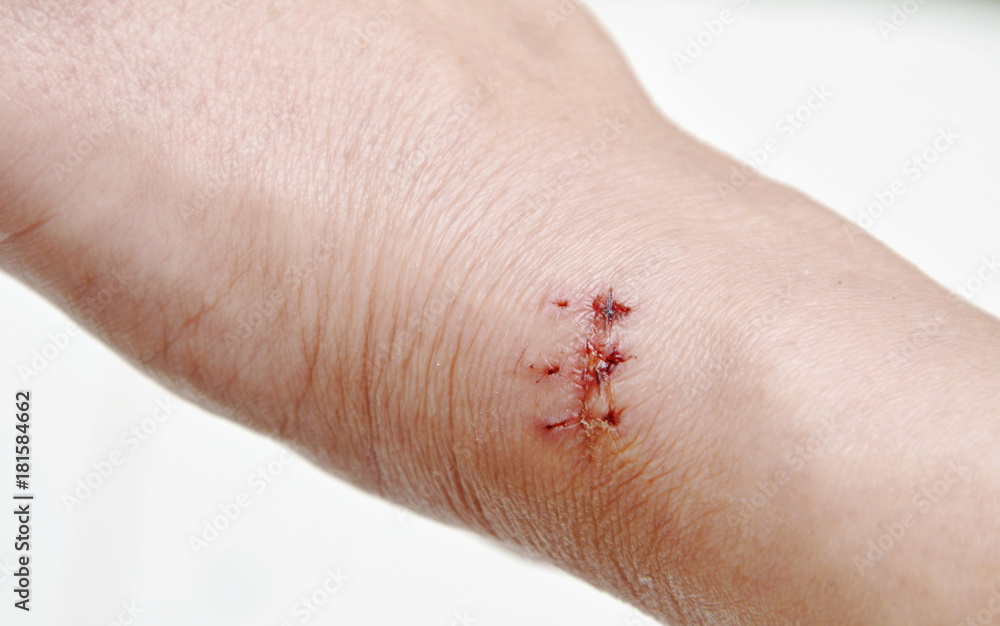 hand with suture scar after surgery on white background hand with suture scar after surgery on white background