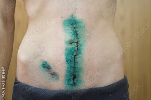 Scars. Crohn's disease. Stitched up wound removal surgery. Incision, postoperative suture. Operative scars in stomach. photo