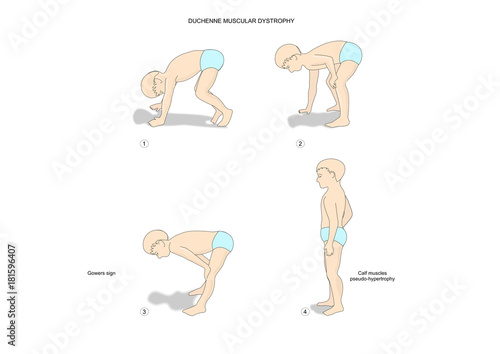 Sequence of movements of a boy with duchenne muscular dystrophy and gowers sign.