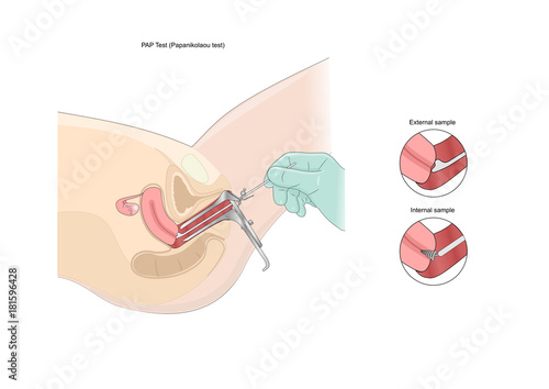 pap test (Papanikolau test), a medical examination of cervix to prevent cancer photo