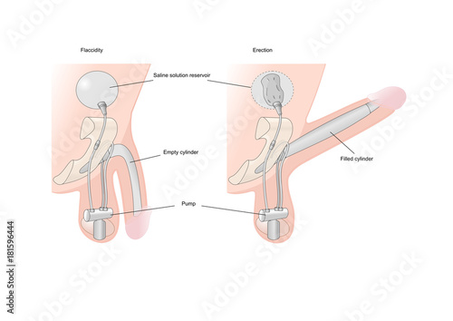 Valokuva a medical prosthesis of penis implantation in case of impotence.