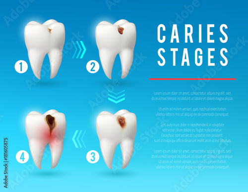 Tooth decay 3d poster of dental caries development