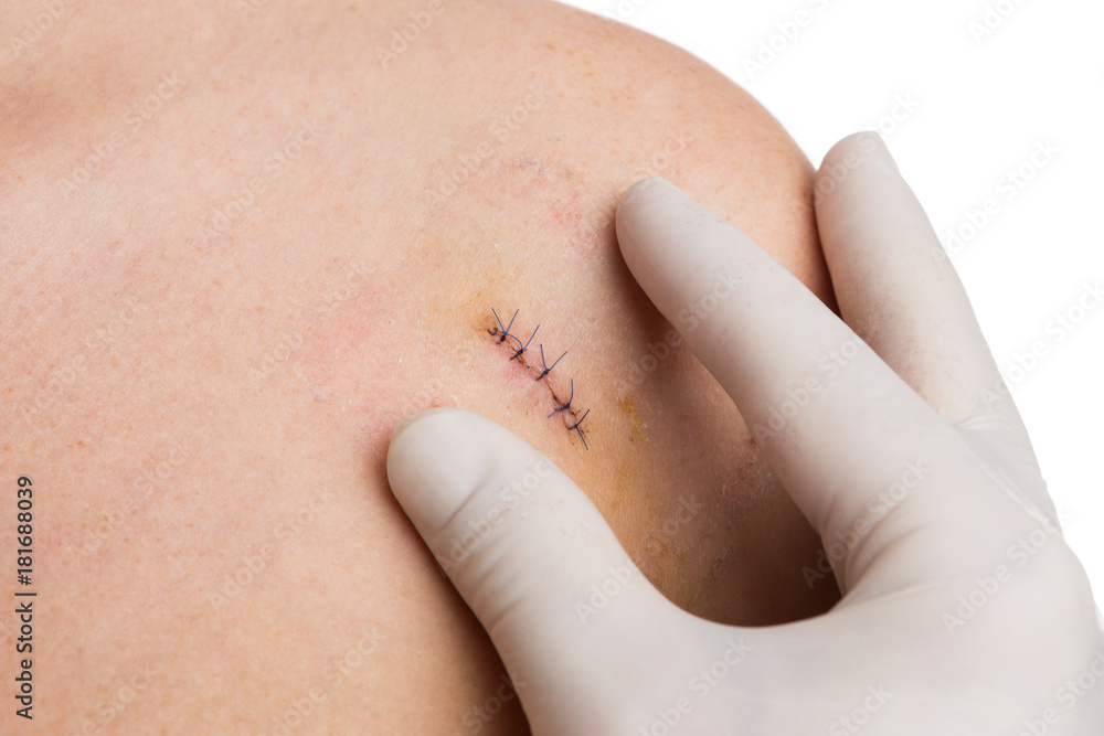 Medic or nurse hands examining fresh suture on woman shoulder Medic or nurse hands examining fresh suture on woman shoulder