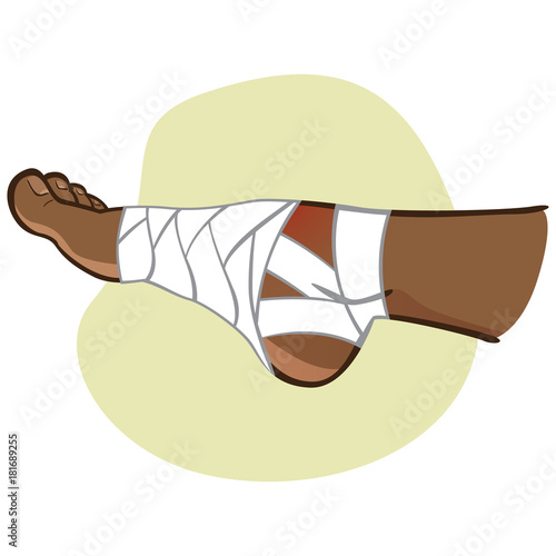 Illustration of first aid afro descendant person, bandaged foot, side view. Ideal for catalogs, information and medicine guides