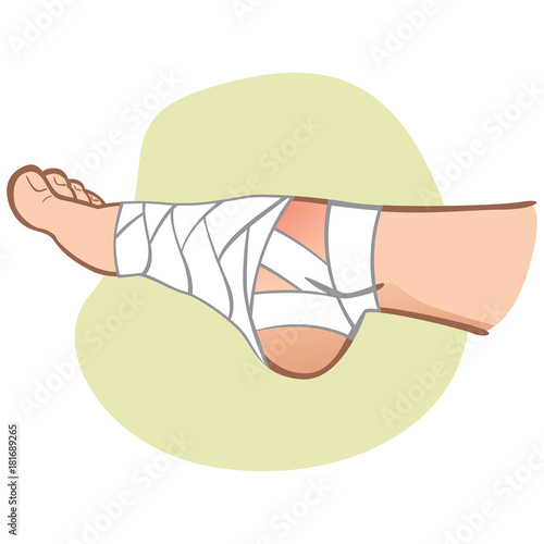 Illustration of first aid person caucasian, foot with ice bag, side view. Ideal for catalogs, information and medicine guides