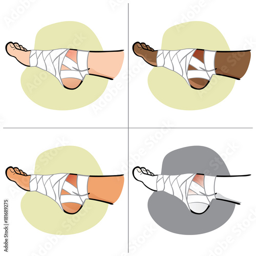 Illustration of first aid person ethnicity, foot with ice bag, side view. Ideal for catalogs, information and medicine guides