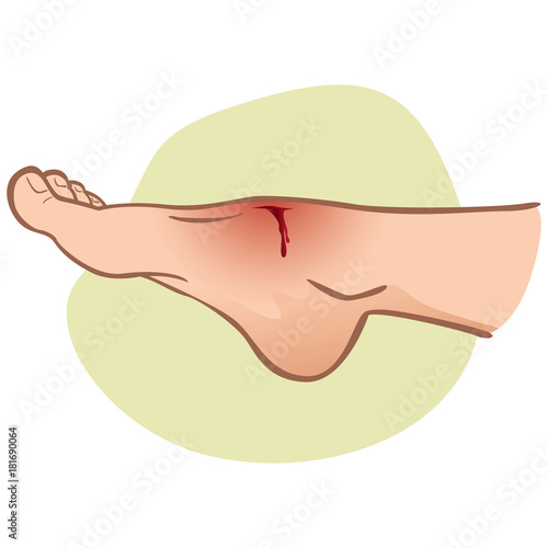 Illustration First Aid person, caucasian, standing side view, with a foot injury, cut with bleeding. Ideal for catalogs, information and medicine guides