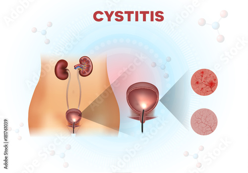 Urinary system anatomy, urinary bladder examination, normal and unhealthy lining with cystitis on a light abstract scientific background