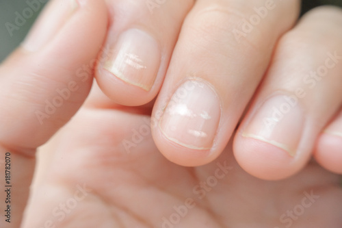 Fotografija close up white spot on finger nails called leukonychia, sickness concept