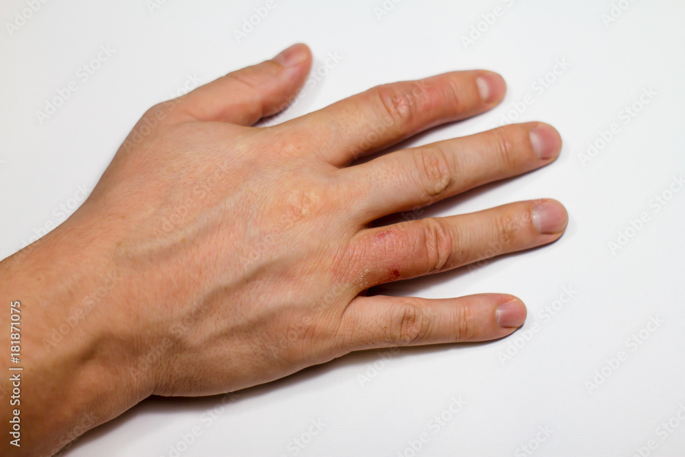 Hand dermatitis. Hand eczema Hand dermatitis. Hand eczema