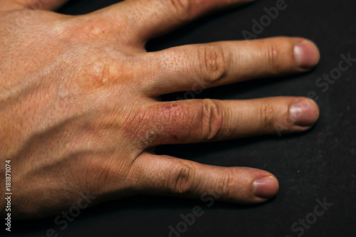 Hand dermatitis. Hand eczema photo