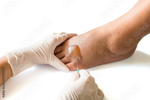 The nurse use the sterilize needle to pierce the scald to drain the liquid