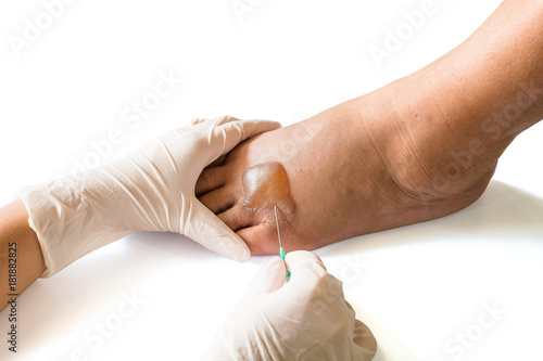 The nurse use the sterilize needle to pierce the scald to drain the liquid photo