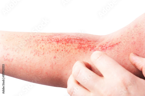 Atopic dermatitis (AD), also known as atopic eczema, is a type of inflammation of the skin (dermatitis) at foot. photo