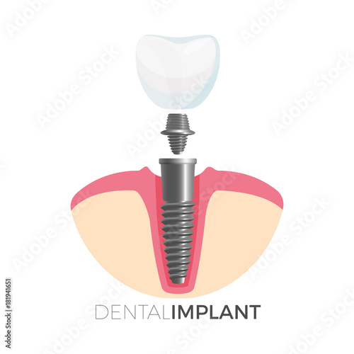 Dental implant tooth and screw on vector illustration