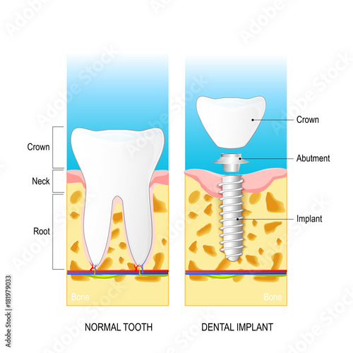 dental implant