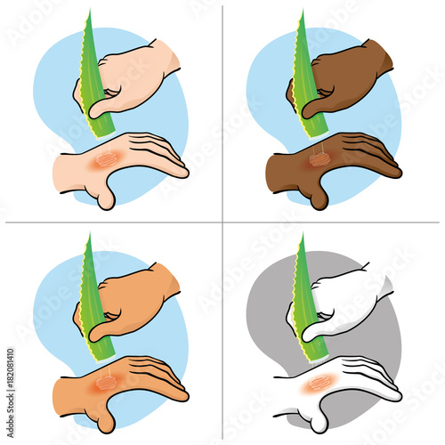 Illustration first aid hands with burn and injury, passing aloe vera, ethnics. Ideal for medical, informative and institutional catalogs