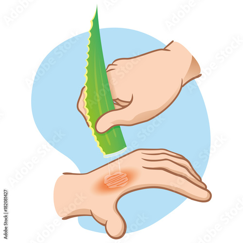 Illustration first aid hands with burn and injury, passing aloe vera, caucasian. Ideal for medical, informative and institutional catalogs