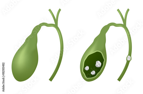 gallbladder and gallstones vector graphic