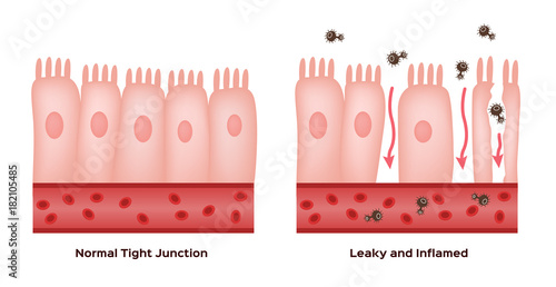 Celiac disease Small intestine lining damage. good and damaged villi . leaky gut progression