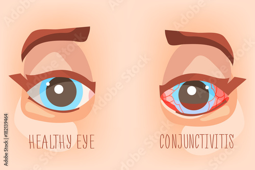 Sick eyes, eye conjunctivitis. Eyecare illustration, healthy and inflammated eyes in cartoon, flat style