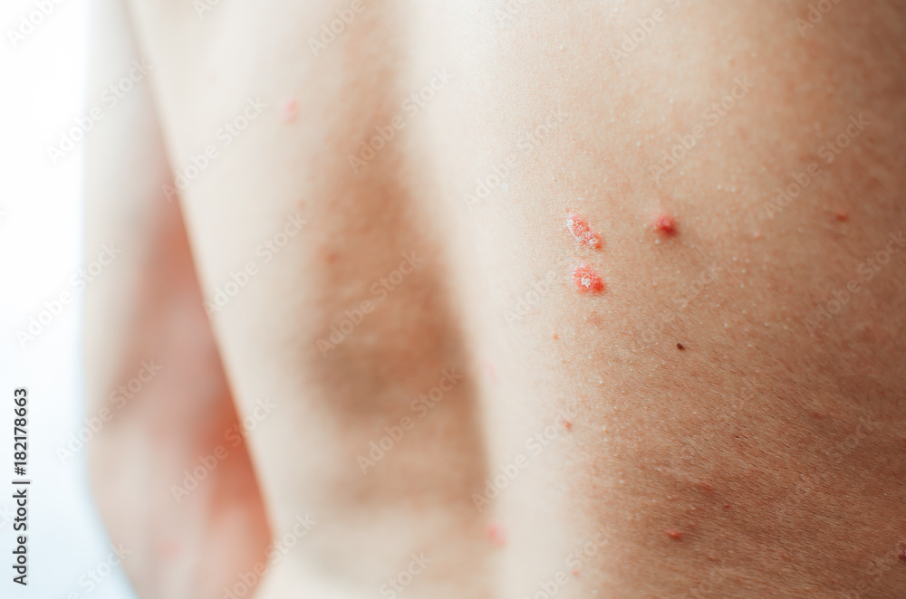 psoriasis, pronounced more at the back psoriasis, pronounced more at the back
