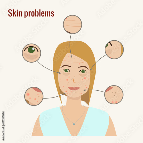Woman's face with skin problems. Wrinckles, acne, pimples, dark circles under eyes. Skin troubles. Skin treatment, rejuvenation. Vector illustration.