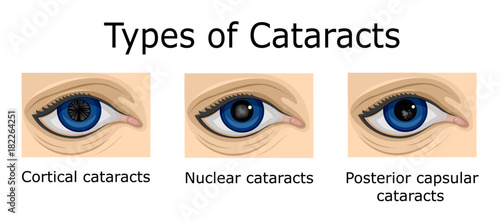 Types of Cataracts