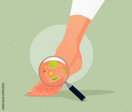 Foot fungus. Vector flat cartoon illustration