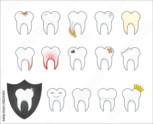 Bad tooth with plaque and cavity. Vector illustration.