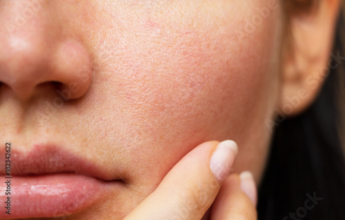 pores on the face
