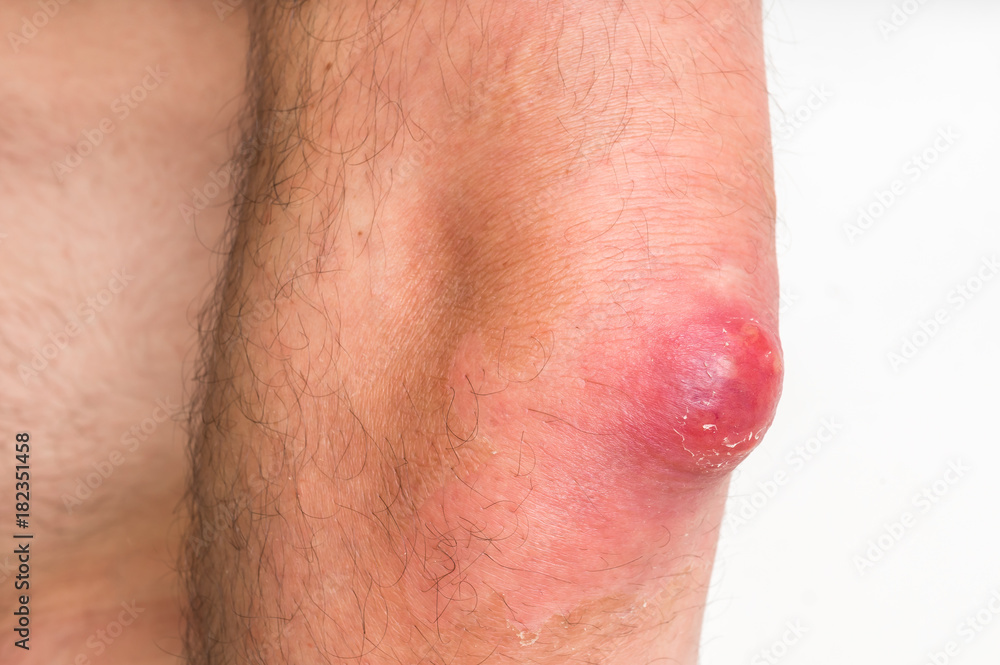 Fototapeta premium Detailed view of elbow with carbuncle or furuncle