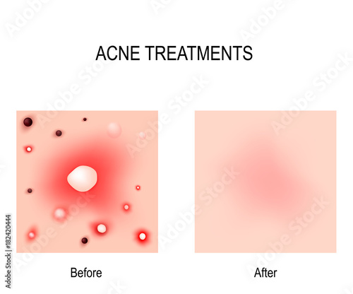 Acne Treatment