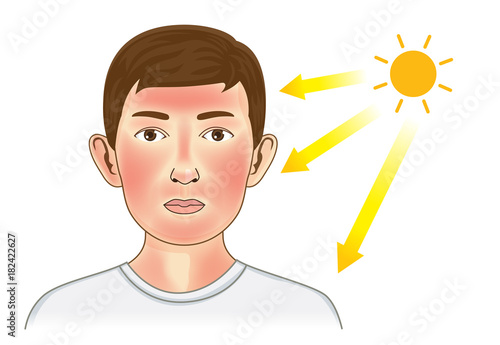 Ultraviolet ray from sun make the redness appear on boy facial and neck skin. Illustration about danger of UV.