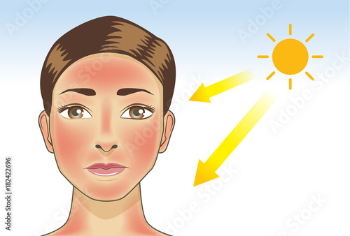 UV ray from sun made the redness appear on woman facial and neck skin. Illustration about danger of Ultraviolet.