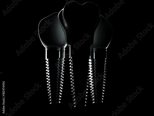 Dental implants isolated