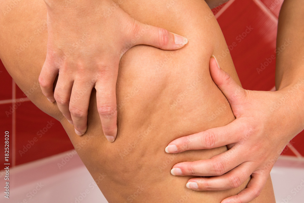Cellulite on the thigh of a fat woman. Cellulite on the thigh of a fat woman.
