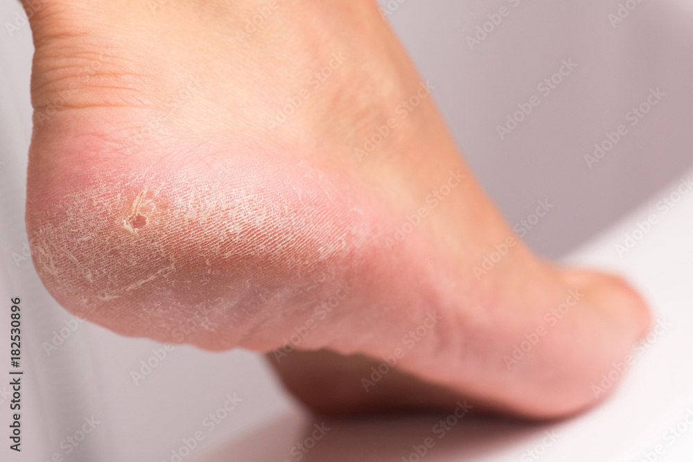 Fototapeta premium Female heel with hardened skin.