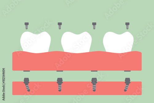 dental prostheses, filling denture on gum