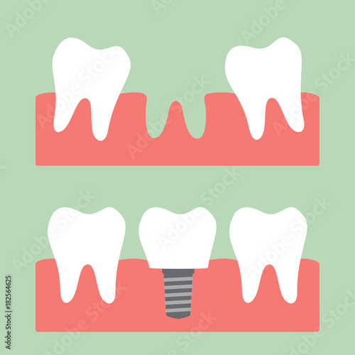 filling dental implant with crown