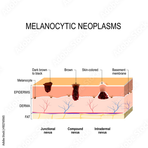 Melanocytic nevus