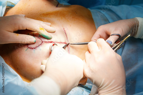 Operation close up. Breast augmentation surger photo