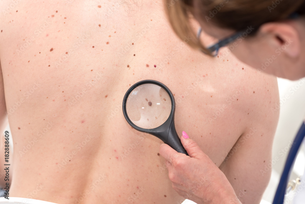 Удаление родинок по доступной цене в Подольске