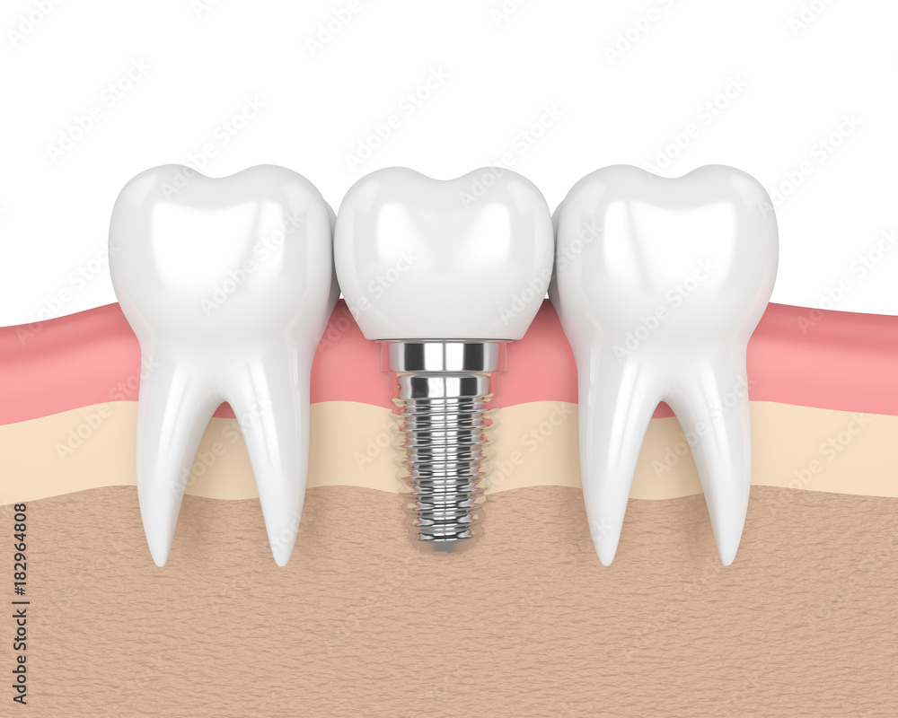 3d render of teeth with dental implant in gums 3d render of teeth with dental implant in gums